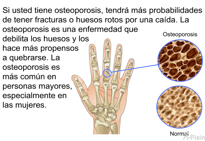 Si usted tiene osteoporosis, tendr ms probabilidades de tener fracturas o huesos rotos por una cada. La osteoporosis es una enfermedad que debilita los huesos y los hace ms propensos a quebrarse. La osteoporosis es ms comn en personas mayores, especialmente en las mujeres.