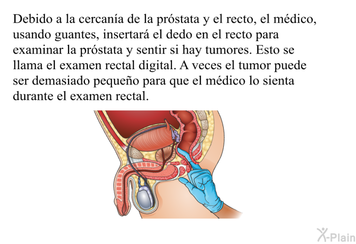 Debido a la cercan�a de la pr�stata y el recto, el m�dico, usando guantes, insertar� el dedo en el recto para examinar la pr�stata y sentir si hay tumores. . Esto se llama el <I>examen rectal digital</I>. A veces el tumor puede ser demasiado peque�o para que el m�dico lo sienta durante el examen rectal.