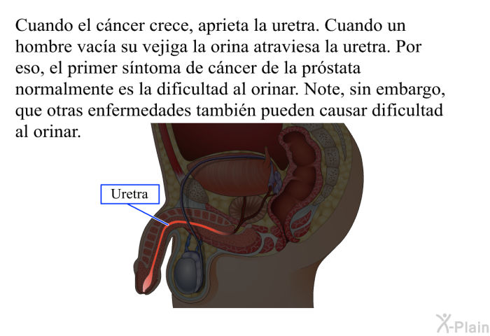 Cuando el c�ncer crece, aprieta la uretra. Cuando un hombre vac�a su vejiga la orina atraviesa la uretra. Por eso, el primer s�ntoma de c�ncer de la pr�stata normalmente es la dificultad al orinar. Note, sin embargo, que otras enfermedades tambi�n pueden causar dificultad al orinar.