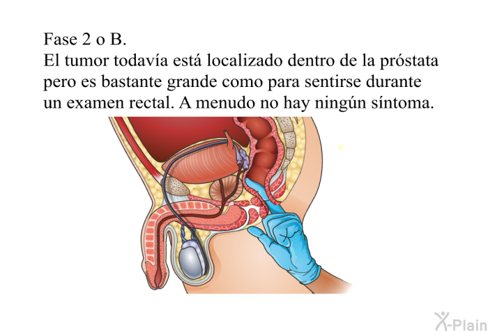 Fase 2 o B. El tumor todav�a est� localizado dentro de la pr�stata pero es bastante grande como para sentirse durante un examen rectal. A menudo no hay ning�n s�ntoma.