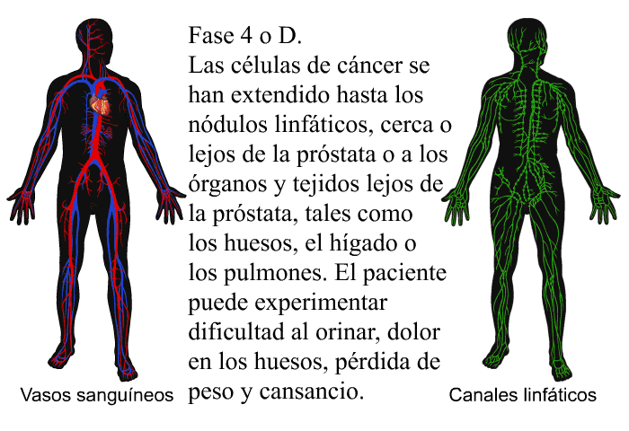 Fase 4 o D. Las c�lulas de c�ncer se han extendido hasta los n�dulos linf�ticos, cerca o lejos de la pr�stata o a los �rganos y tejidos lejos de la pr�stata, tales como los huesos, el h�gado o los pulmones. El paciente puede experimentar dificultad al orinar, dolor en los huesos, p�rdida de peso y cansancio.