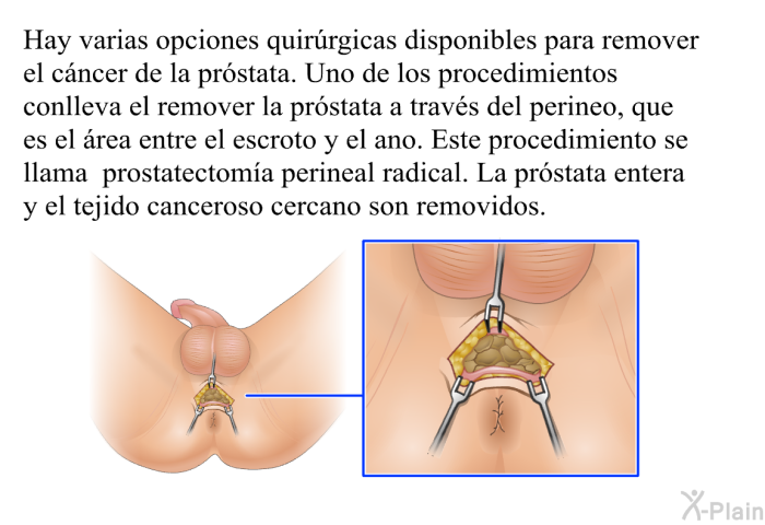 Hay varias opciones quir�rgicas disponibles para remover el c�ncer de la pr�stata. Uno de los procedimientos conlleva el remover la pr�stata a trav�s del perineo, que es el �rea entre el escroto y el ano. Este <I>procedimiento se llama prostatectom�a</I> perineal radical. La pr�stata entera y el tejido canceroso cercano son removidos.