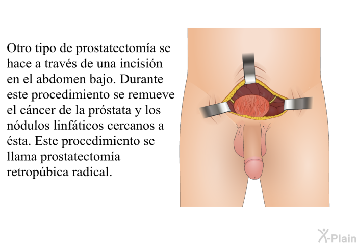 Otro tipo de prostatectom�a<B> </B>se hace a trav�s de una incisi�n en el abdomen bajo. Durante este procedimiento se remueve el c�ncer de la pr�stata y los n�dulos linf�ticos cercanos a �sta. Este procedimiento se llama <I>prostatectom�a retrop�bica radical</I>.