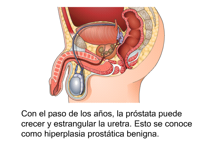 Con el paso de los aos, la prstata puede crecer y estrangular la uretra. Esto se conoce como hiperplasia prosttica benigna.
