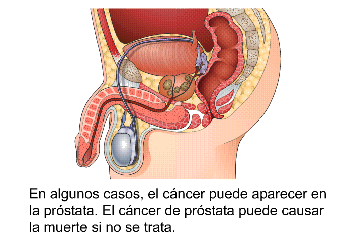 En algunos casos, el cncer puede aparecer en la prstata. El cncer de prstata puede causar la muerte si no se trata.