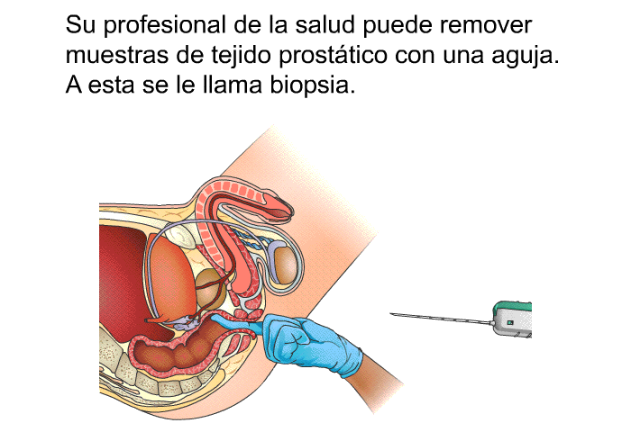 Su profesional de la salud puede remover muestras de tejido prost�tico con una aguja. A esta se le llama biopsia.