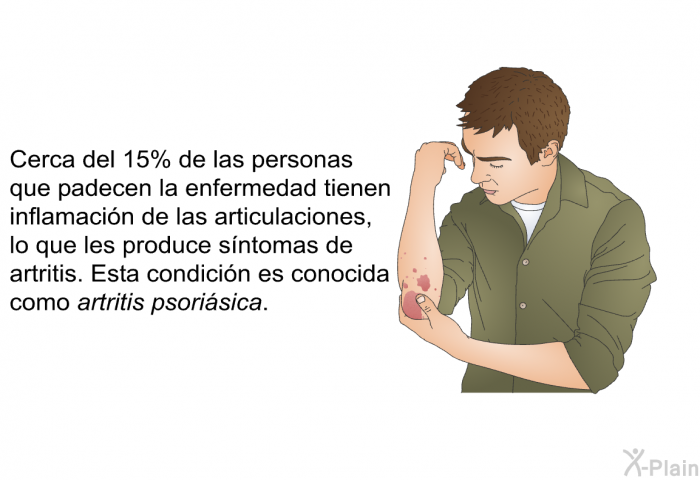 Cerca del 15% de las personas que padecen la enfermedad tienen inflamacin de las articulaciones, lo que les produce sntomas de artritis. Esta condicin es conocida como <I>artritis psorisica</I>. 