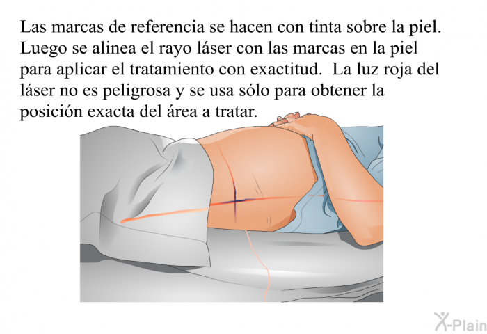 Las marcas de referencia se hacen con tinta sobre la piel. Luego se alinea el rayo lser con las marcas en la piel para aplicar el tratamiento con exactitud. La luz roja del lser no es peligrosa y se usa slo para obtener la posicin exacta del rea a tratar.