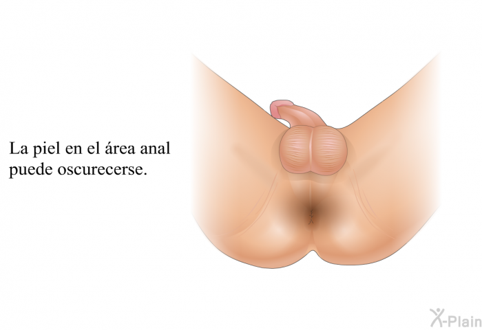 La piel en el rea anal puede oscurecerse.