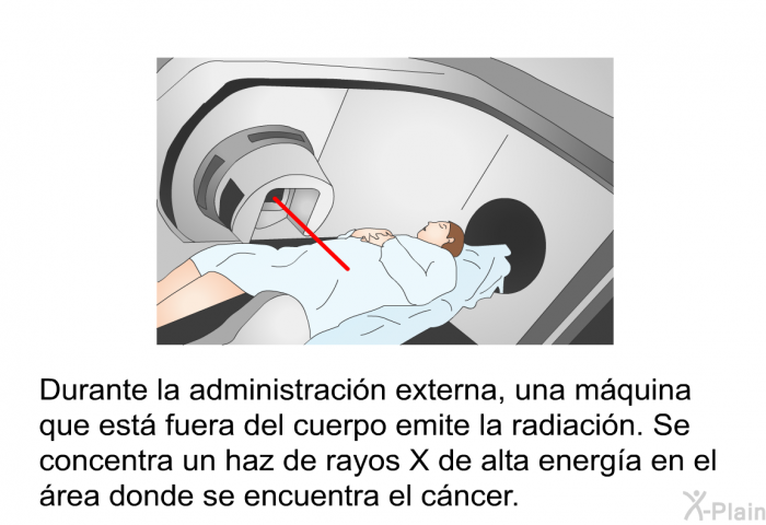 Durante la administracin externa, una mquina que est fuera del cuerpo emite la radiacin. Se concentra un haz de rayos X de alta energa en el rea donde se encuentra el cncer.
