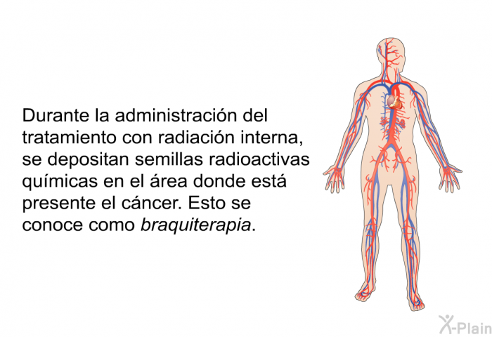 Durante la administracin del tratamiento con radiacin interna, se depositan semillas radioactivas qumicas en el rea donde est presente el cncer. Esto se conoce como <I>braquiterapia</I>.