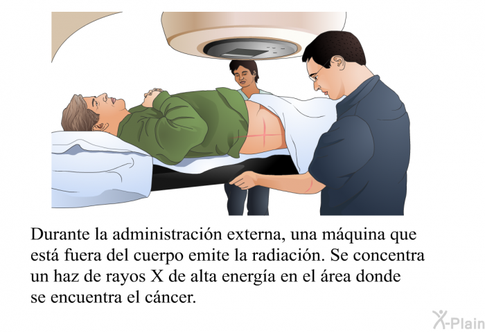 Durante la administracin externa, una mquina que est fuera del cuerpo emite la radiacin. Se concentra un haz de rayos X de alta energa en el rea donde se encuentra el cncer.