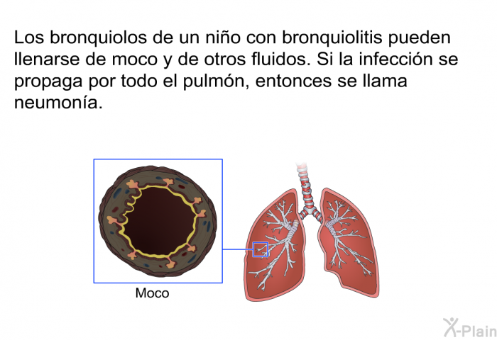 Los bronquiolos de un nio con bronquiolitis pueden llenarse de moco y de otros fluidos. Si la infeccin se propaga por todo el pulmn, entonces se llama neumona.