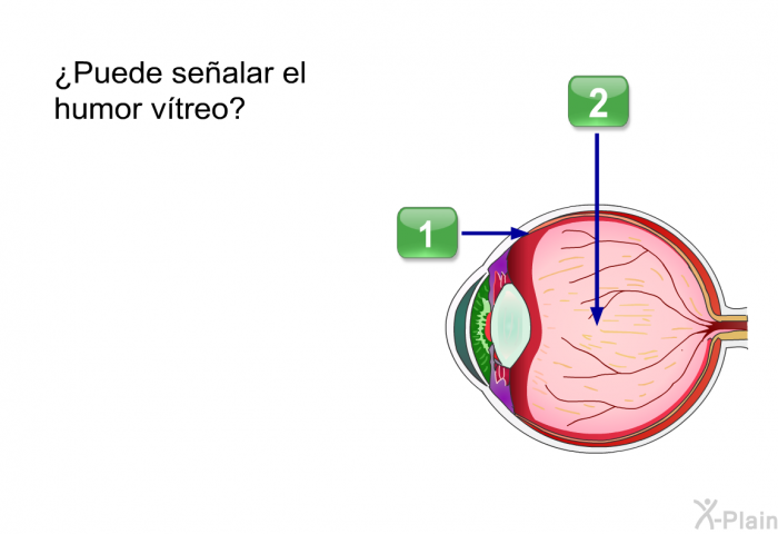 ¿Puede sealar el humor vtreo?