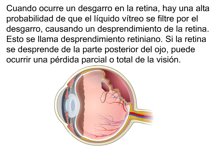 Cuando ocurre un desgarro en la retina, hay una alta probabilidad de que el lquido vtreo se filtre por el desgarro, causando un desprendimiento de la retina. Esto se llama desprendimiento retiniano. Si la retina se desprende de la parte posterior del ojo, puede ocurrir una prdida parcial o total de la visin.