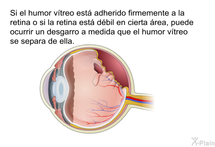 Si el humor vtreo est adherido firmemente a la retina o si la retina est dbil en cierta rea, puede ocurrir un desgarro a medida que el humor vtreo se separa de ella.