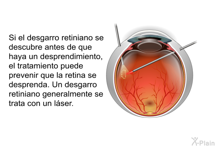 Si el desgarro retiniano se descubre antes de que haya un desprendimiento, el tratamiento puede prevenir que la retina se desprenda. Un desgarro retiniano generalmente se trata con un lser.