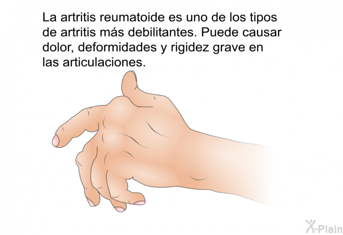 La artritis reumatoide es uno de los tipos de artritis ms debilitantes. Puede causar dolor, deformidades y rigidez grave en las articulaciones.