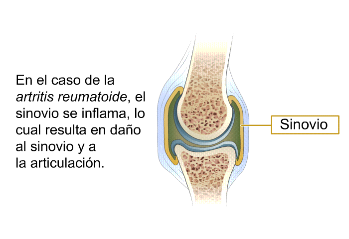 En el caso de la <I>artritis reumatoide</I>, el sinovio se inflama, lo cual resulta en dao al sinovio y a la articulacin.