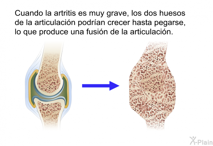 Cuando la artritis es muy grave, los dos huesos de la articulacin podran crecer hasta pegarse, lo que produce una fusin de la articulacin.
