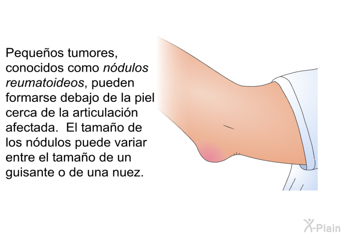 Pequeos tumores, conocidos como <I>ndulos reum</I><I>atoideos</I>, pueden formarse debajo de la piel cerca de la articulacin afectada. El tamao de los ndulos puede variar entre el tamao de un guisante o de una nuez.