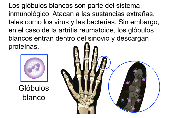 Los gl�bulos blancos son parte del sistema inmunol�gico. Atacan a las sustancias extra�as, tales como los virus y las bacterias. Sin embargo, en el caso de la artritis reumatoide, los gl�bulos blancos entran dentro del sinovio y descargan prote�nas.