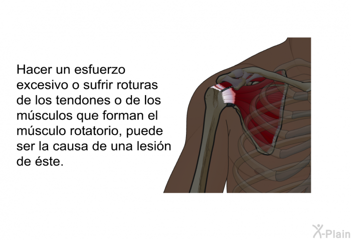 Hacer un esfuerzo excesivo o sufrir roturas de los tendones o de los msculos que forman el msculo rotatorio, puede ser la causa de una lesin de ste.