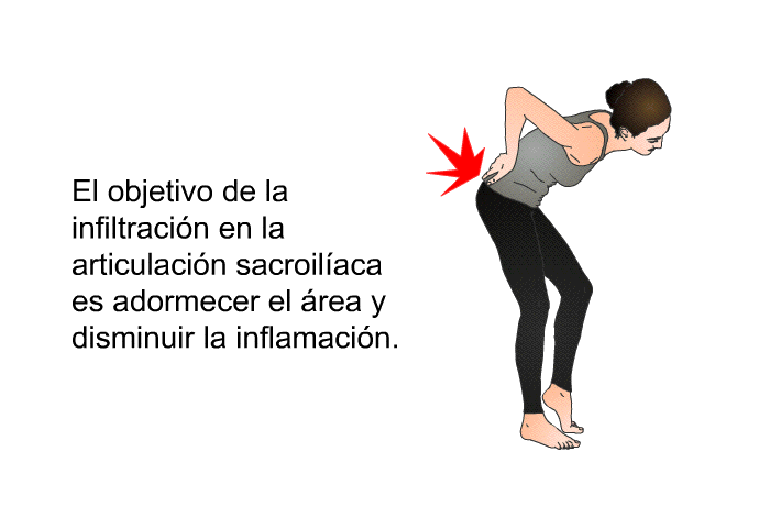 El objetivo de la infiltracin en la articulacin sacroilaca es adormecer el rea y disminuir la inflamacin.