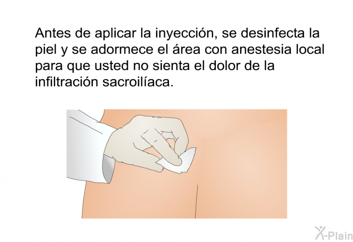 Antes de aplicar la inyeccin, se desinfecta la piel y se adormece el rea con anestesia local para que usted no sienta el dolor de la infiltracin sacroilaca.