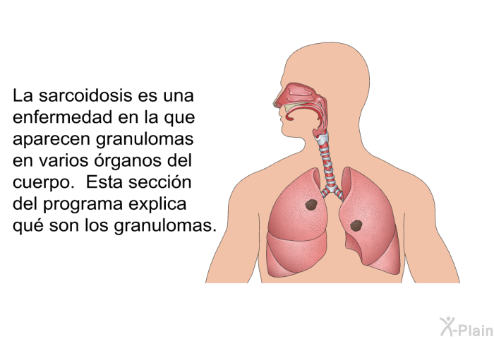 La sarcoidosis es una enfermedad en la que aparecen granulomas en varios rganos del cuerpo. Esta seccin del programa explica qu son los granulomas.