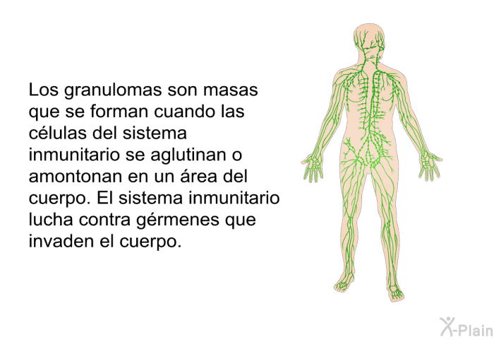 Los granulomas son masas que se forman cuando las clulas del sistema inmunitario se aglutinan o amontonan en un rea del cuerpo. El sistema inmunitario lucha contra grmenes que invaden el cuerpo.