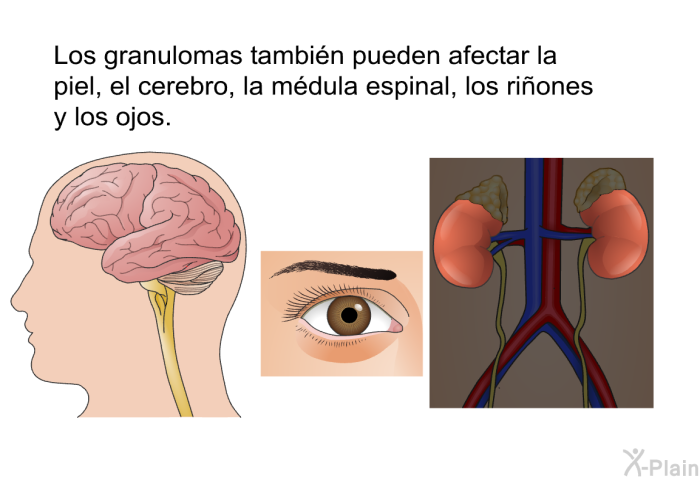 Los granulomas tambin pueden afectar la piel, el cerebro, la mdula espinal, los riones y los ojos.