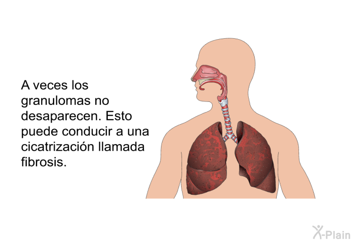 A veces los granulomas no desaparecen. Esto puede conducir a una cicatrizacin llamada <I>fibrosis</I>.