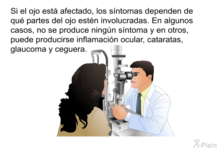 Si el ojo est afectado, los sntomas dependen de qu partes del ojo estn involucradas. En algunos casos, no se produce ningn sntoma y en otros, puede producirse inflamacin ocular, cataratas, glaucoma y ceguera.