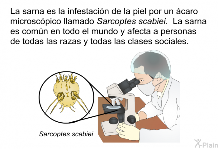 La sarna es la infestacin de la piel por un caro microscpico llamado Sarcoptes scabiei. La sarna es comn en todo el mundo y afecta a personas de todas las razas y todas las clases sociales.