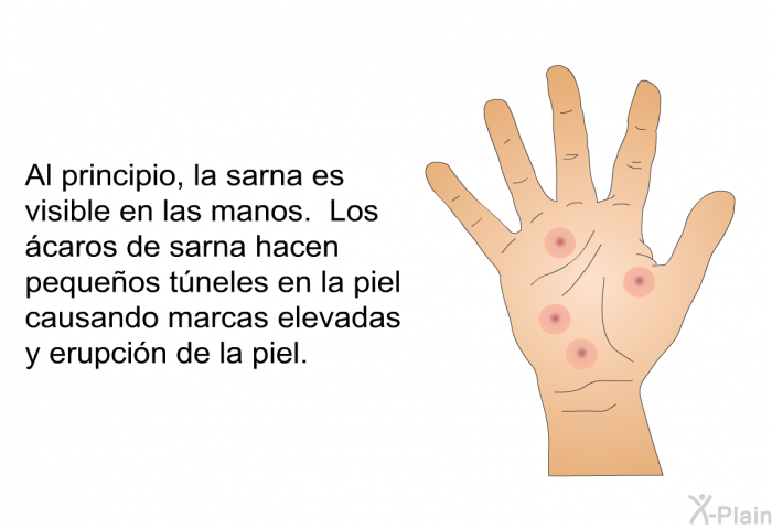 Al principio, la sarna es visible en las manos. Los caros de sarna hacen pequeos tneles en la piel causando marcas elevadas y erupcin de la piel.