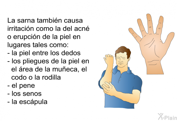 La sarna tambin causa irritacin como la del acn o erupcin de la piel en lugares tales como:  la piel entre los dedos los pliegues de la piel en el rea de la mueca, el codo o la rodilla el pene los senos la escpula