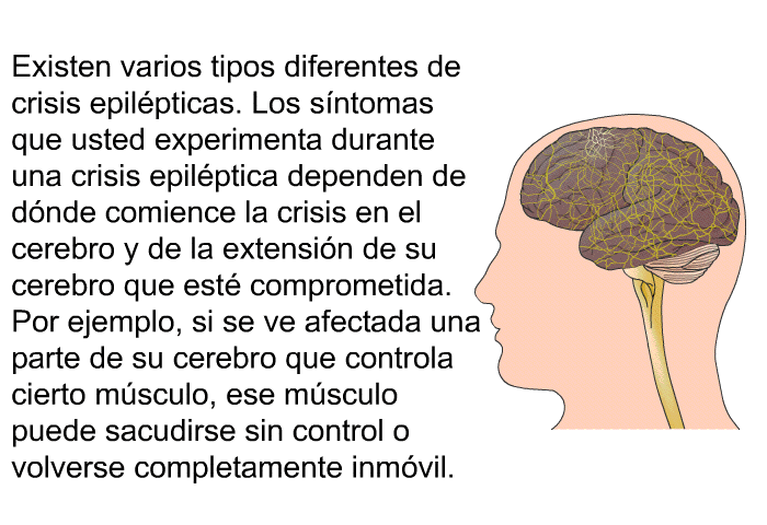 Existen varios tipos diferentes de crisis epilpticas. Los sntomas que usted experimenta durante una crisis epilptica dependen de dnde comience la crisis en el cerebro y de la extensin de su cerebro que est comprometida. Por ejemplo, si se ve afectada una parte de su cerebro que controla cierto msculo, ese msculo puede sacudirse sin control o volverse completamente inmvil.