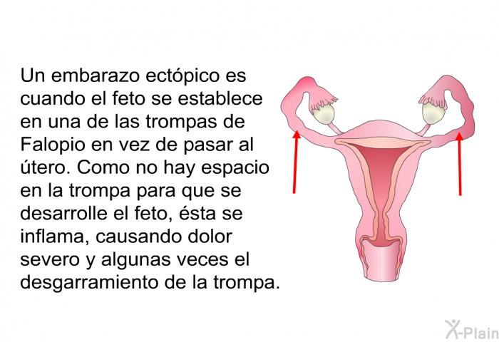 Un embarazo ectpico es cuando el feto se establece en una de las trompas de Falopio en vez de pasar al tero. Como no hay espacio en la trompa para que se desarrolle el feto, sta se inflama, causando dolor severo y algunas veces el desgarramiento de la trompa.