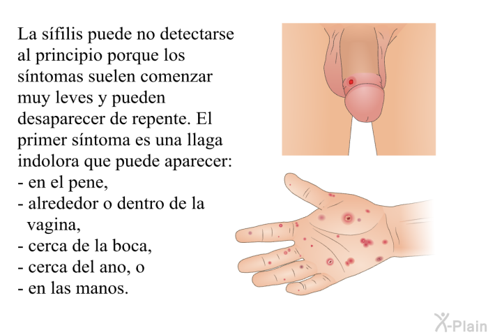 La s�filis puede no detectarse al principio porque los s�ntomas suelen comenzar muy leves y pueden desaparecer de repente. El primer s�ntoma es una llaga indolora que puede aparecer:  en el pene, alrededor o dentro de la vagina, cerca de la boca, cerca del ano, o en las manos.