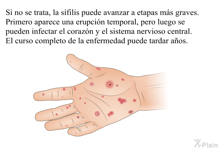 Si no se trata, la sfilis puede avanzar a etapas ms graves. Primero aparece una erupcin temporal, pero luego se pueden infectar el corazn y el sistema nervioso central. El curso completo de la enfermedad puede tardar aos.