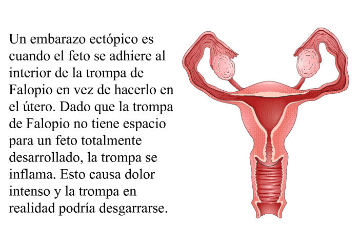 Un embarazo ect�pico es cuando el feto se adhiere al interior de la trompa de Falopio en vez de hacerlo en el �tero. Dado que la trompa de Falopio no tiene espacio para un feto totalmente desarrollado, la trompa se inflama. Esto causa dolor intenso y la trompa en realidad podr�a desgarrarse.