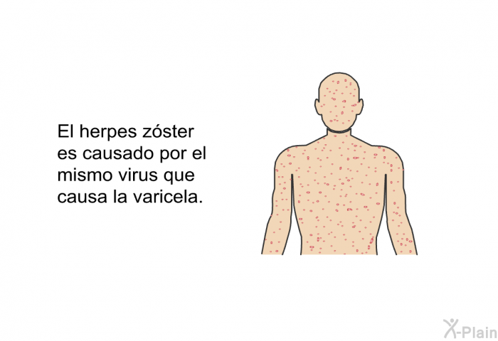 El herpes z<STRONG>ster es causado por el mismo virus que causa la varicela.