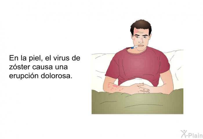 En la piel, el virus de z<STRONG>ster causa una erupcin dolorosa.