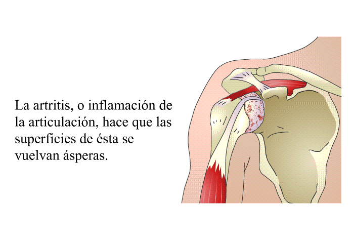 La artritis, o inflamacin de la articulacin, hace que las superficies de sta se vuelvan speras.