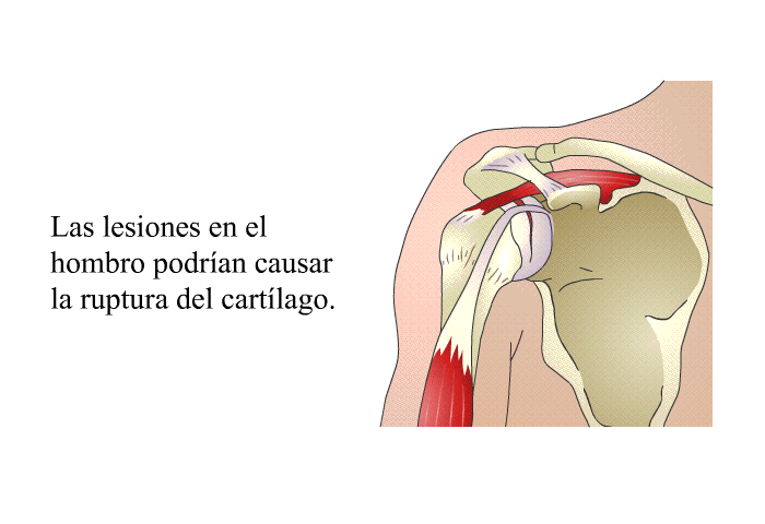 Las lesiones en el hombro podran causar la ruptura del cartlago.