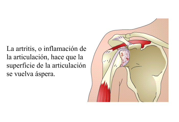 La artritis, o inflamacin de la articulacin, hace que la superficie de la articulacin se vuelva spera.