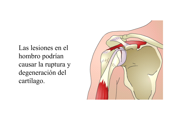 Las lesiones en el hombro podran causar la ruptura y degeneracin del cartlago.