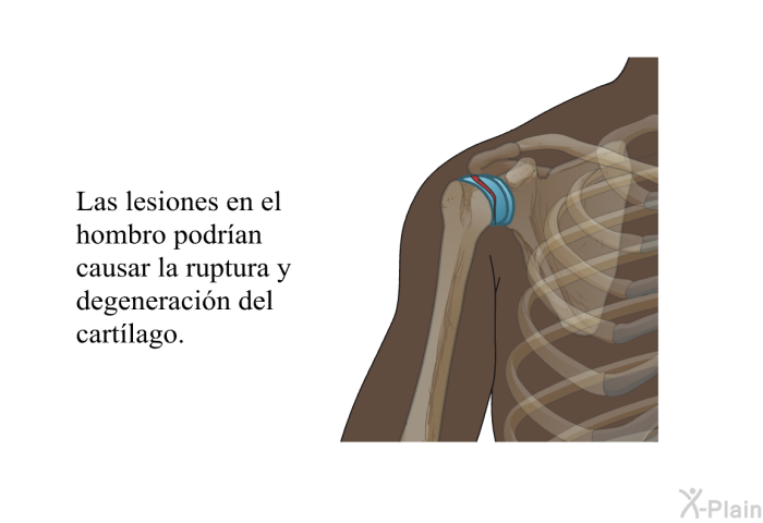 Las lesiones en el hombro podran causar la ruptura y degeneracin del cartlago.