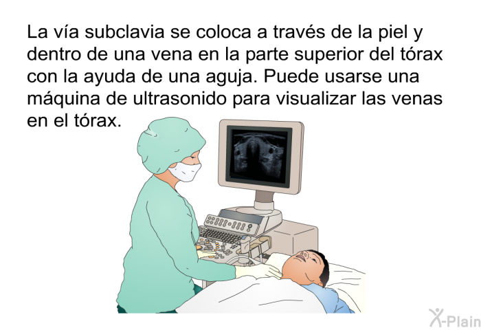 La va subclavia se coloca a travs de la piel y dentro de una vena en la parte superior del trax con la ayuda de una aguja. Puede usarse una mquina de ultrasonido para visualizar las venas en el trax.